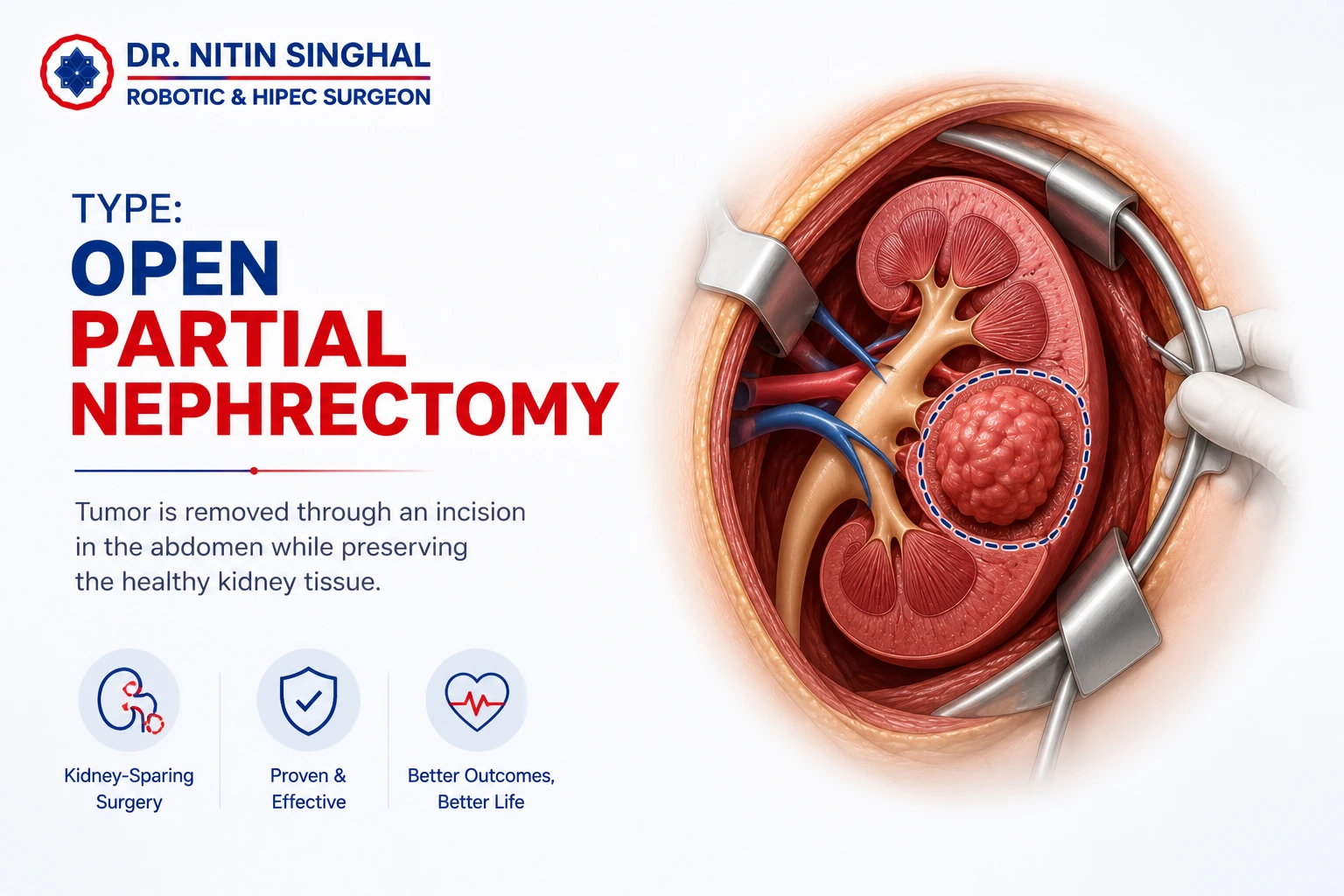 Open partial nephrectomy technique