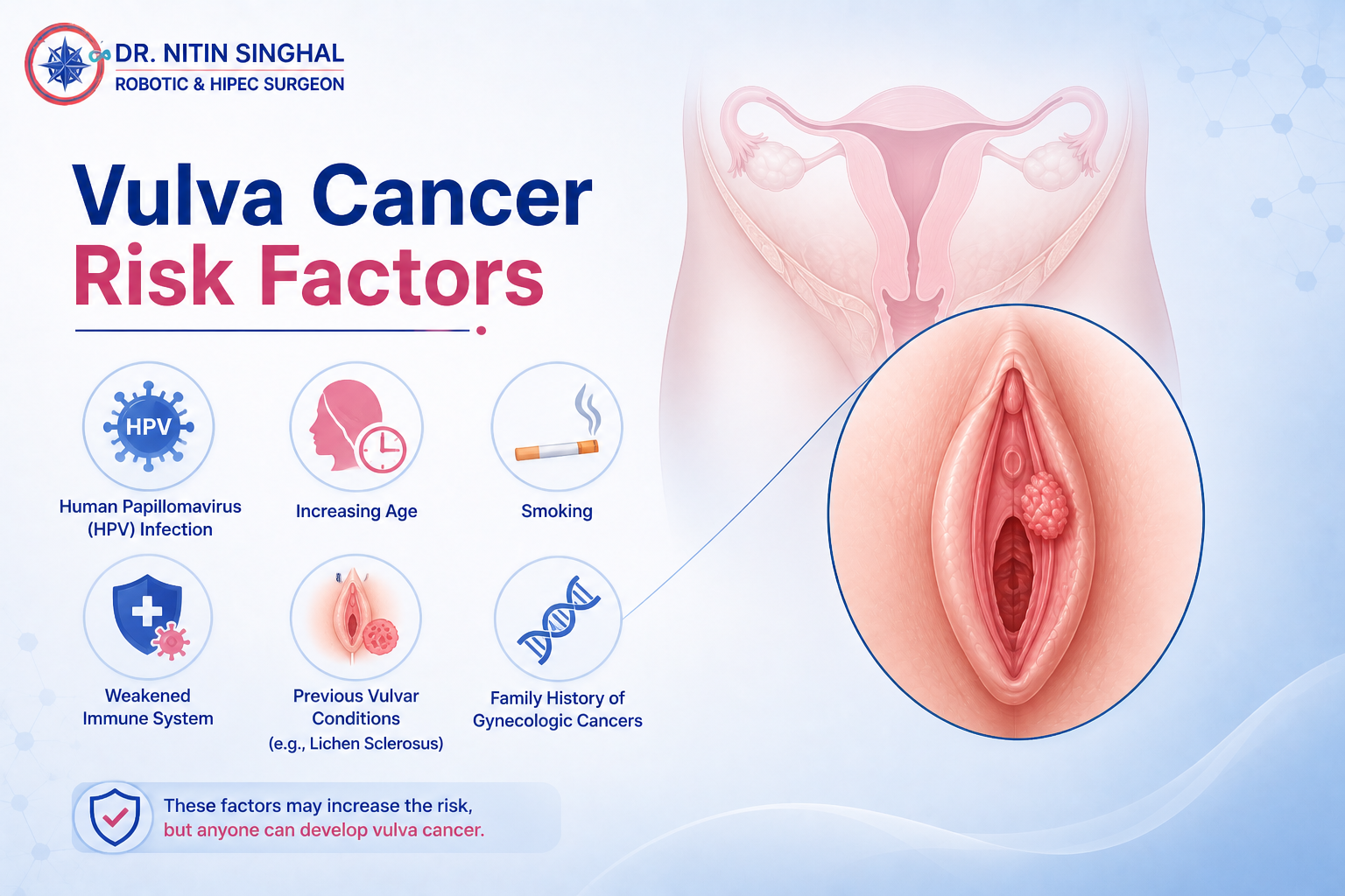 Vulvar cancer risk factors illustration