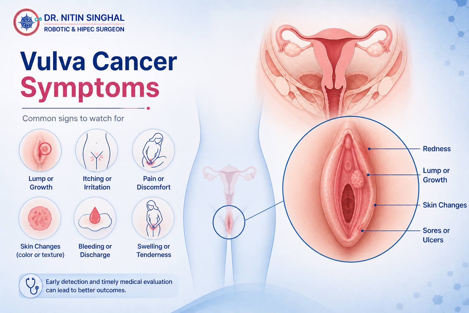 Vulvar cancer symptoms illustration