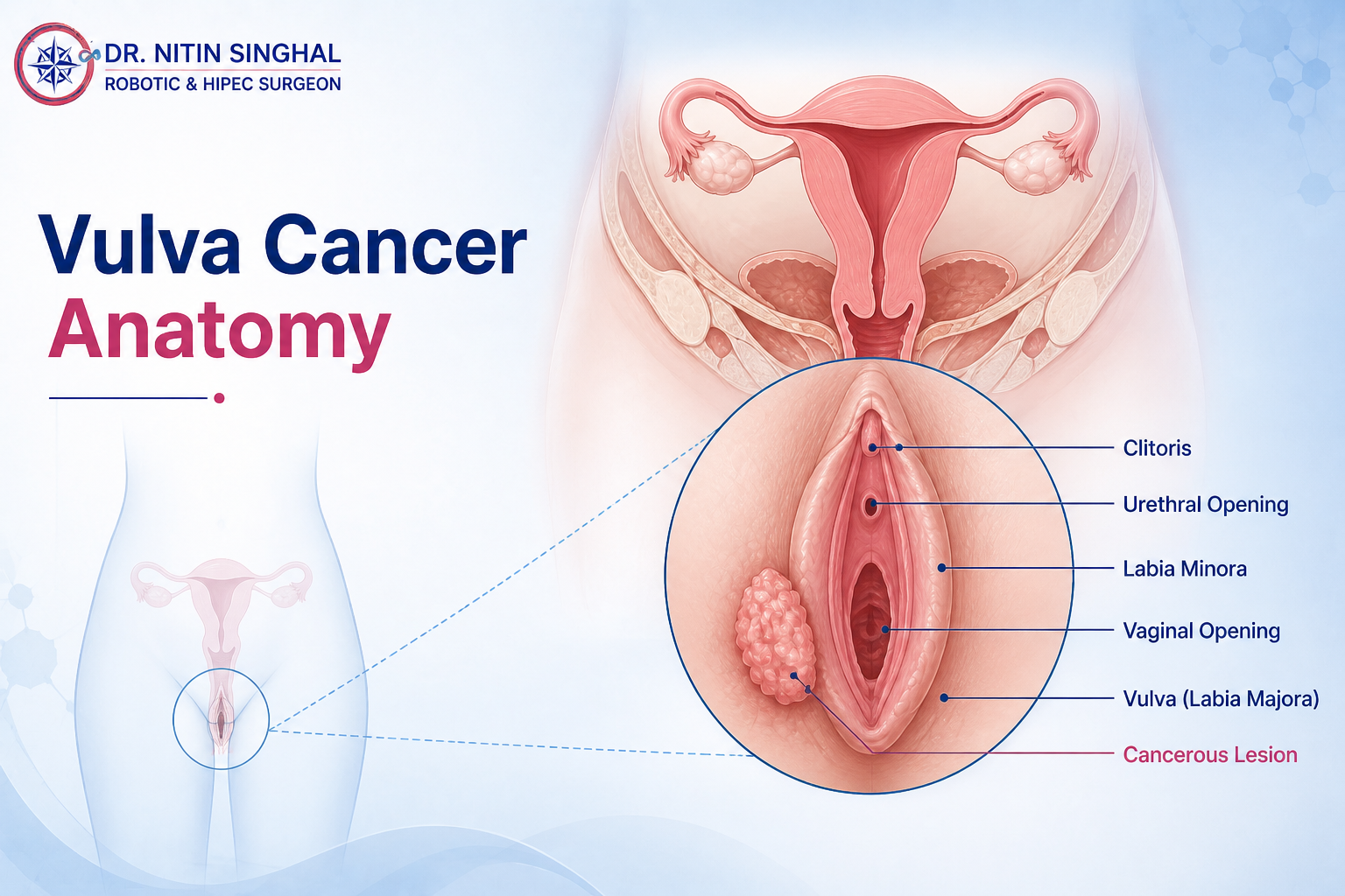 Vulva anatomy illustration — vulvar cancer