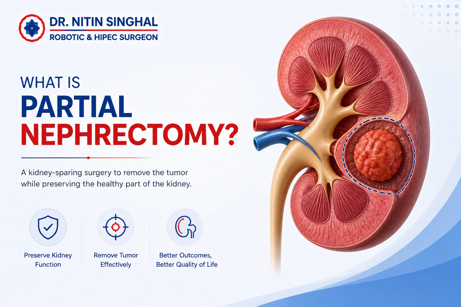 Overview of partial nephrectomy surgery