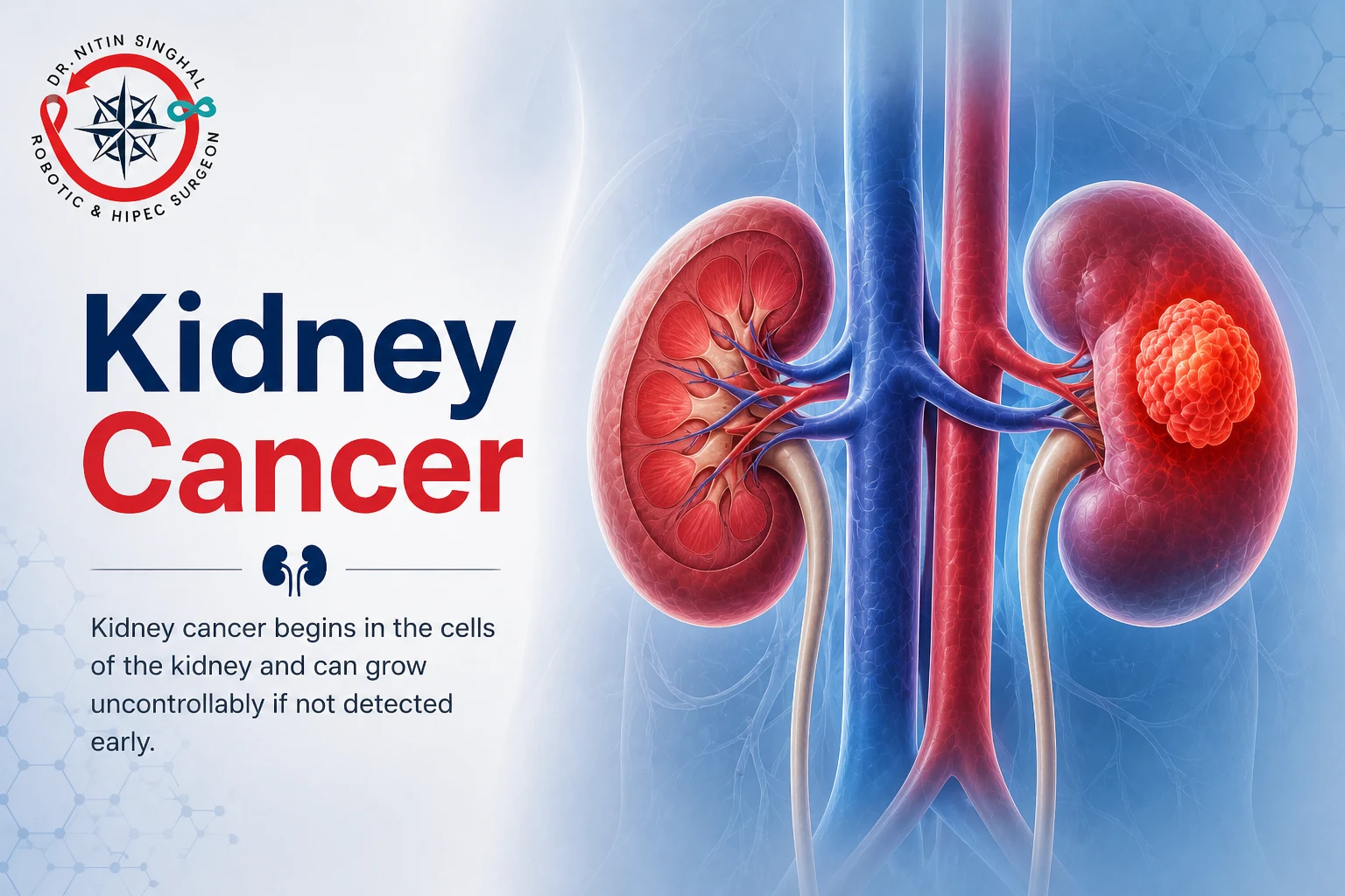 Kidney cancer illustration - tumour on kidney, Dr. Nitin Singhal Robotic and HIPEC Surgeon