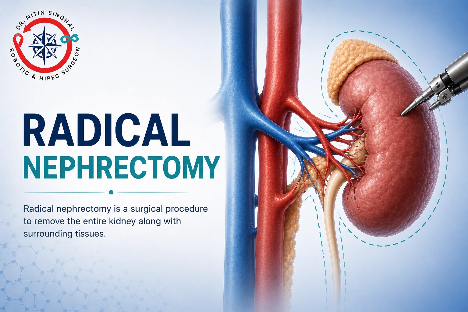Robotic radical nephrectomy illustration - complete kidney removal, Dr. Nitin Singhal Robotic and HIPEC Surgeon