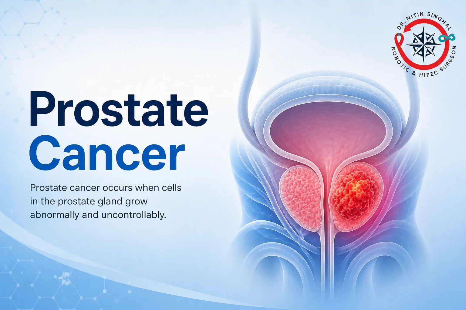 Robotic prostate cancer surgery — Dr. Nitin Singhal, Ahmedabad