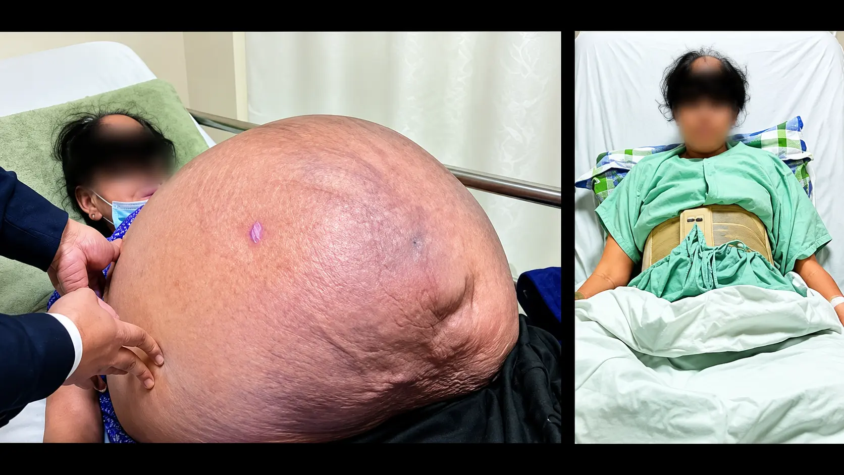 47 kg tumor removal surgery Ahmedabad — Dr Nitin Singhal, Times of India coverage